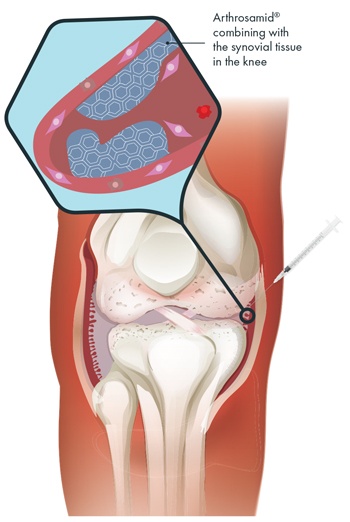 Arthrosamid®